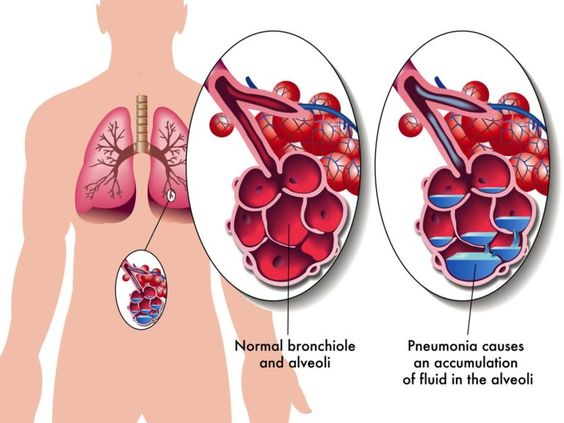 Normal lung and pneumonia illness