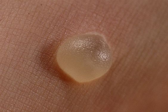 popping blister could make scar mark and treat longer