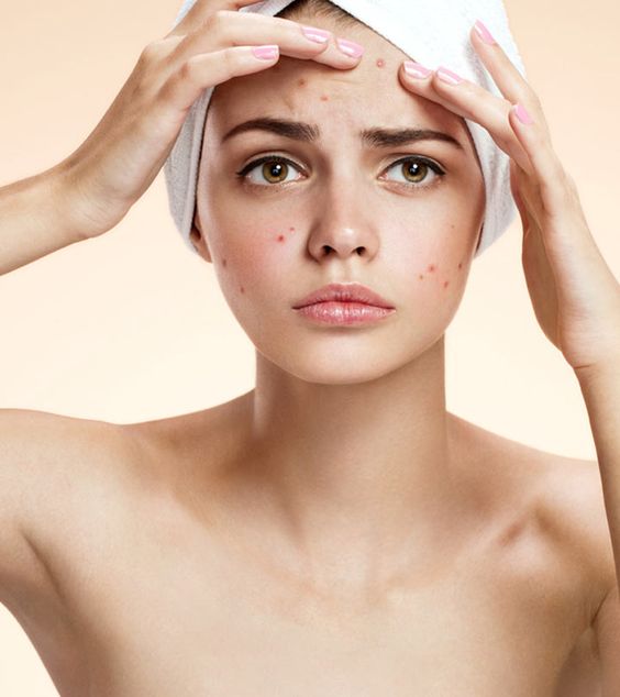 Pimple is acne symptom that commonly appear in young people