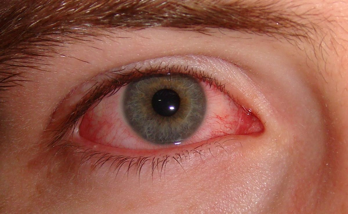 common eye infection such as conjunctivitis