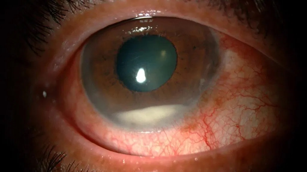 white build up on endophthalmitis case causes by eye infection