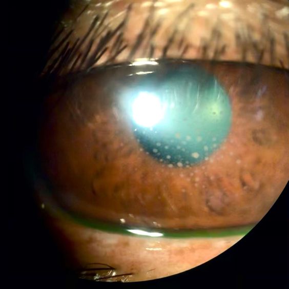 Uveitis is one of harmful eye infection