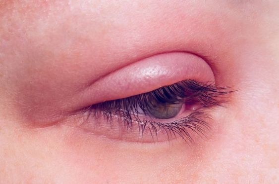 blepahritis is swelling eye infection on eyelids