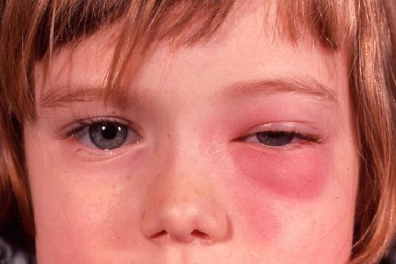 inflammation by orbital cellulitis as eye infection