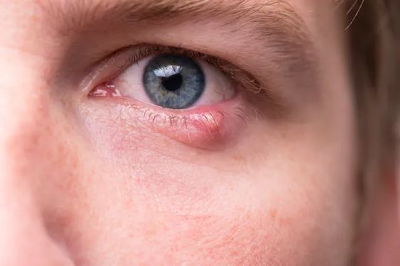 styes or sty eye infection